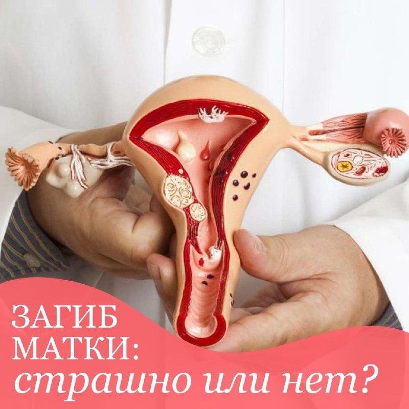 Bend of the uterus what a woman needs to