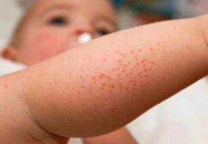 Red spots and irritations on the babys skin first